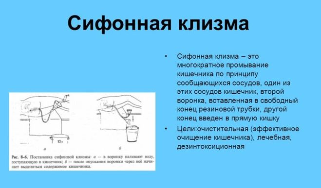 Что такое сифонная клизма? Кому показана и как поставить самому дома?